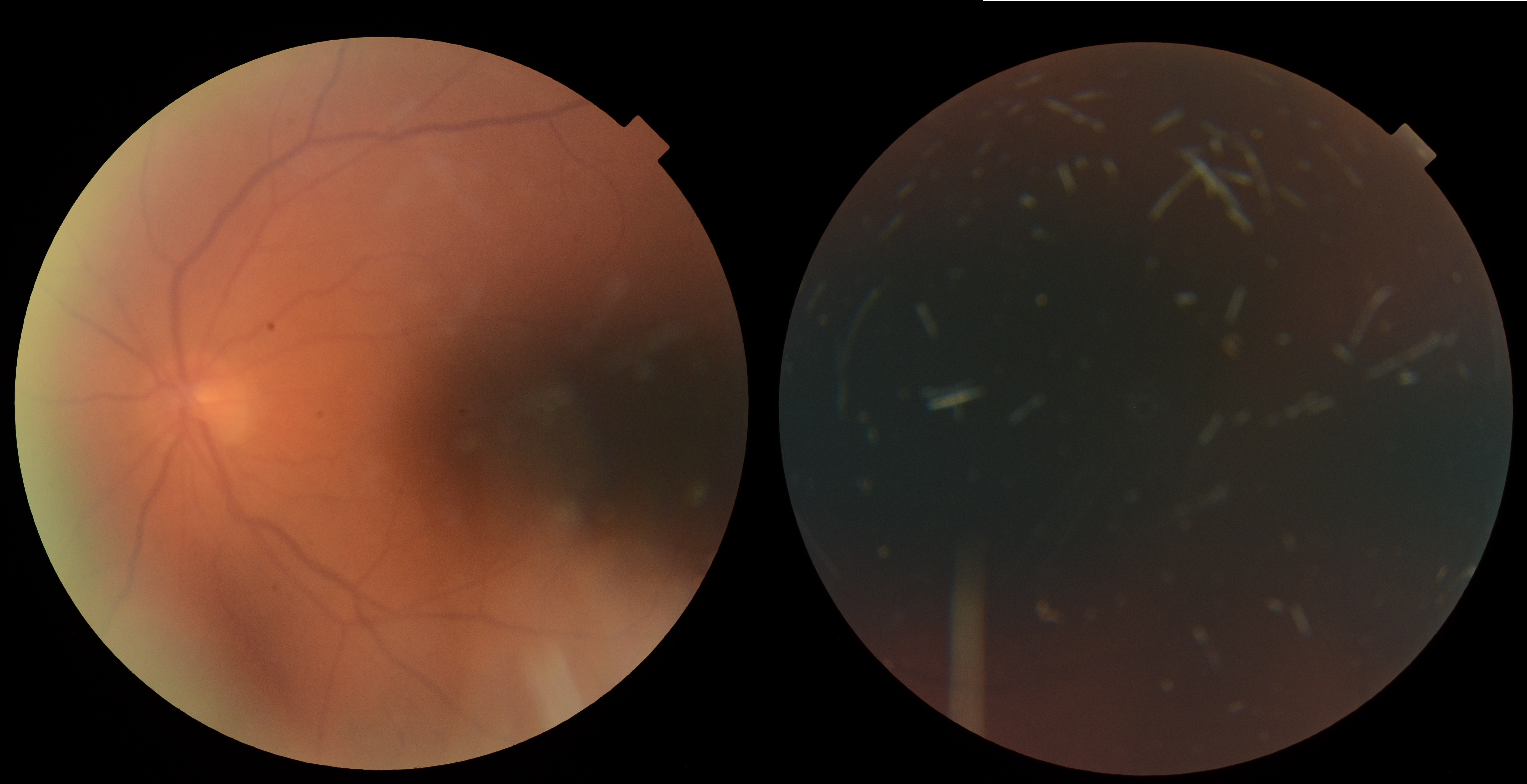 Case Study: Elevated IOP After Steroid Use 