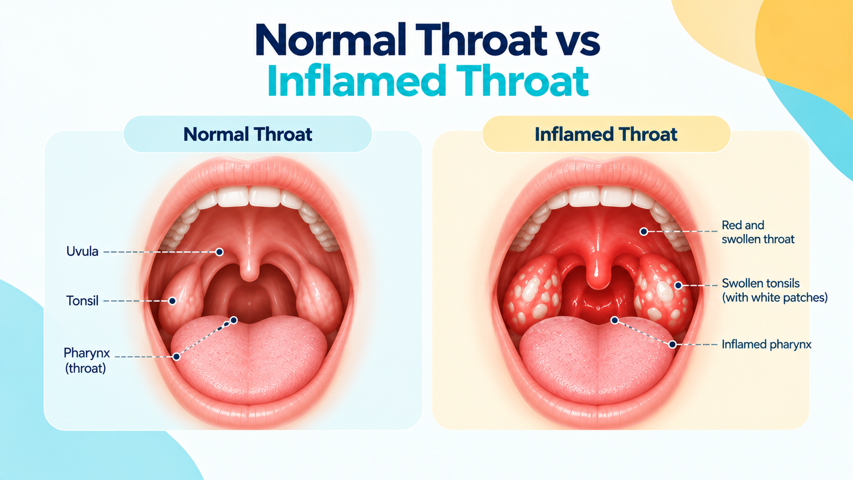 Normal vs Inflamed Throat Comparison.png