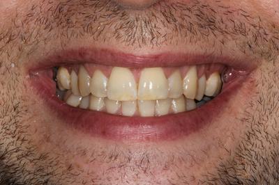 Teeth Whitening 1