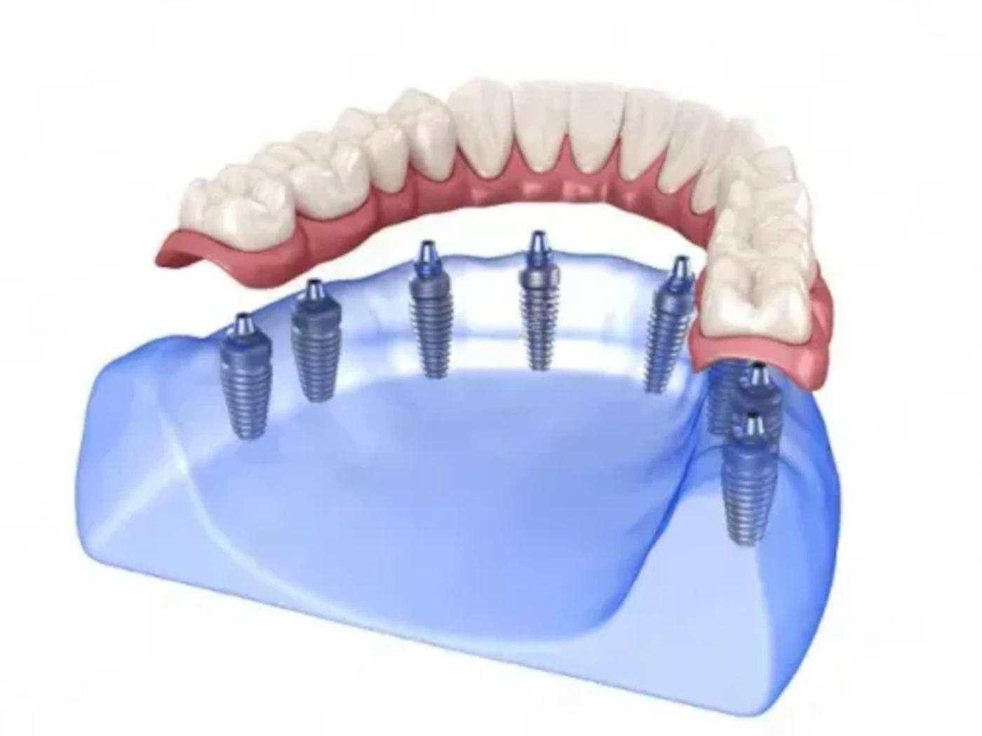 Illustration of an upper jaw dental implant with several metal posts and a full set of teeth.