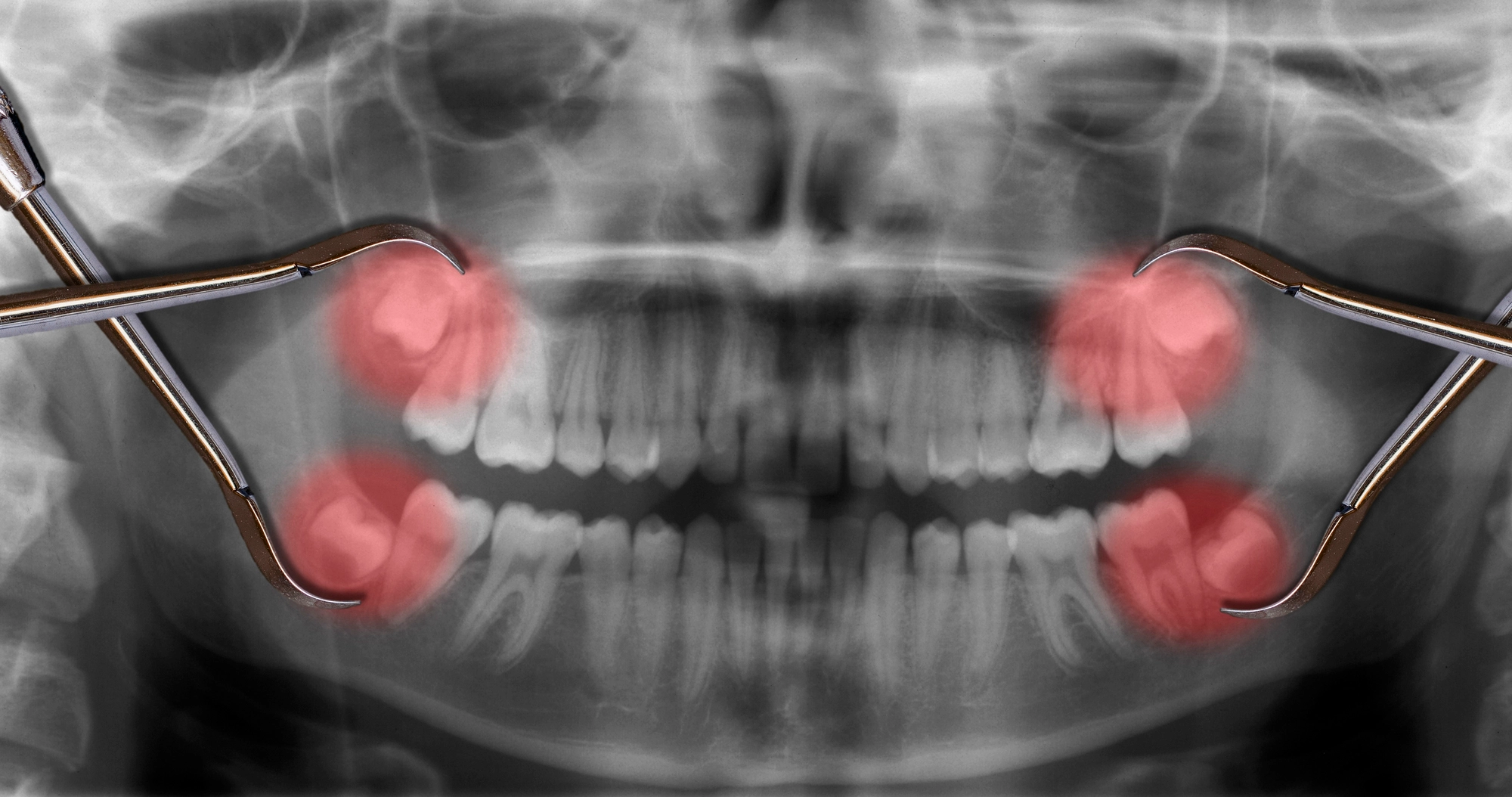 Panoramic dental X-ray showing four impacted wisdom teeth highlighted in red, held by dental extraction tools on both sides
