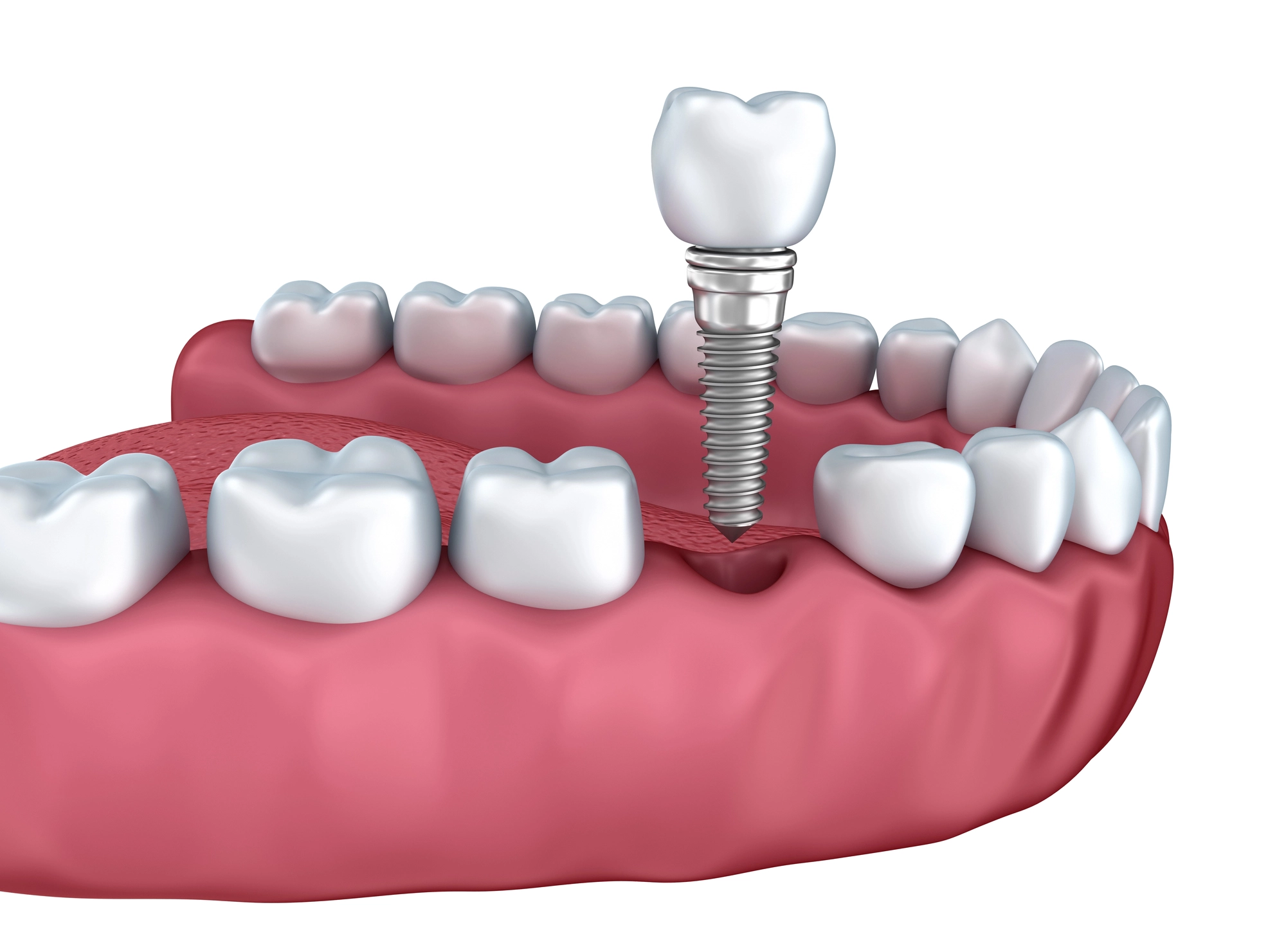 3D illustration of a dental implant screw being placed into the gum, replacing a missing tooth in the lower jaw