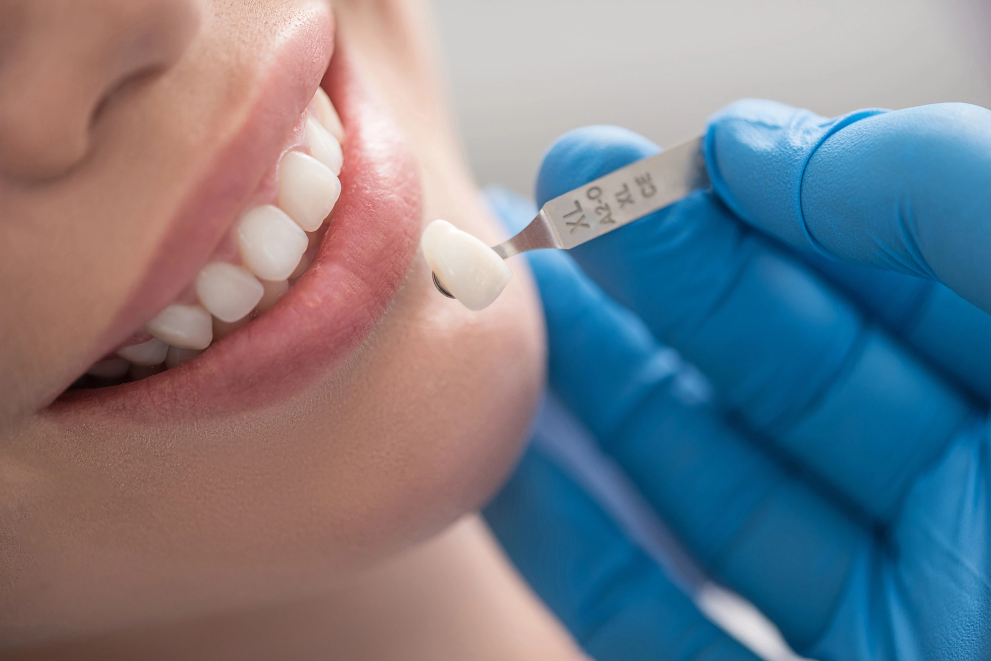 Close-up of dentist matching a dental veneer to a patient's tooth using a shade guide