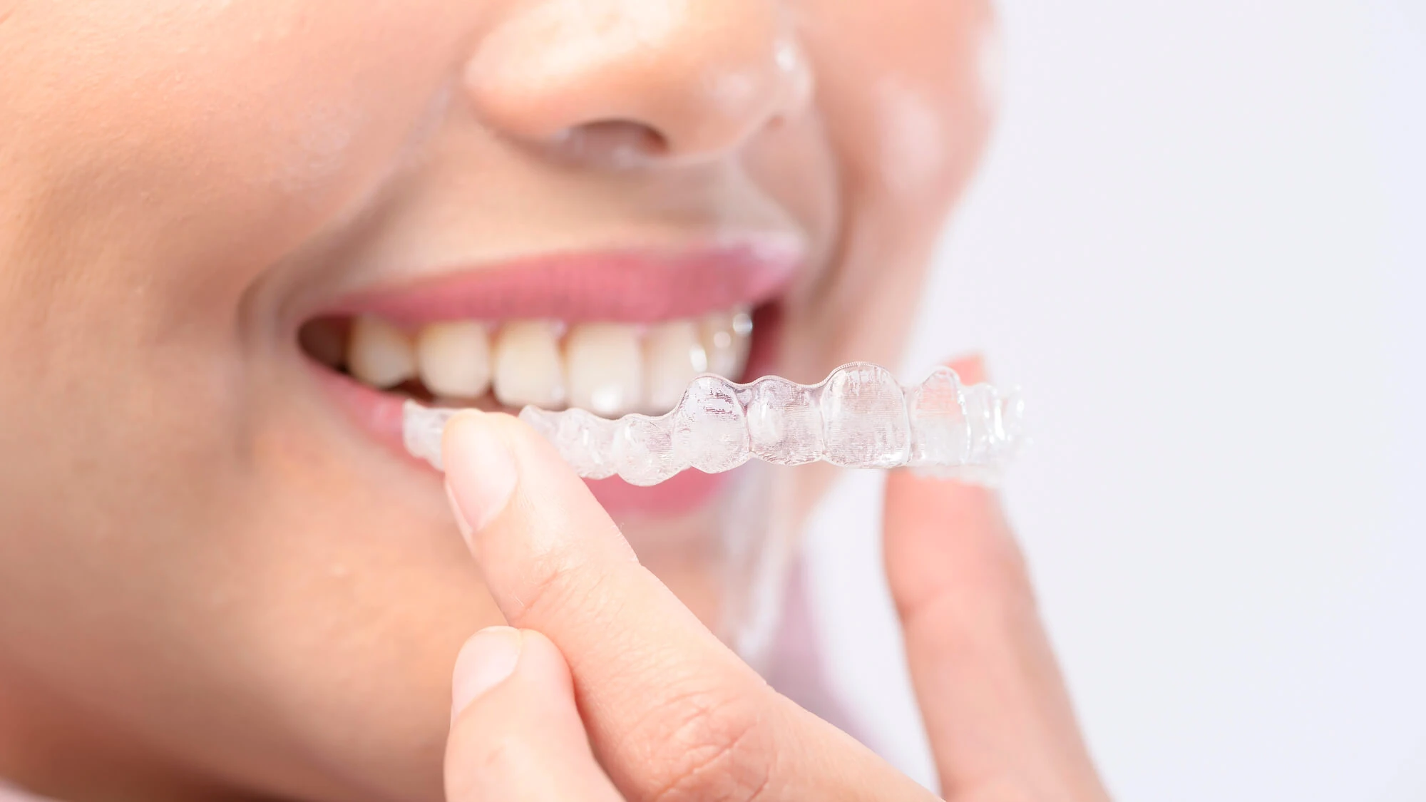 Close-up of a patient placing a clear aligner while looking for Invisalign near me