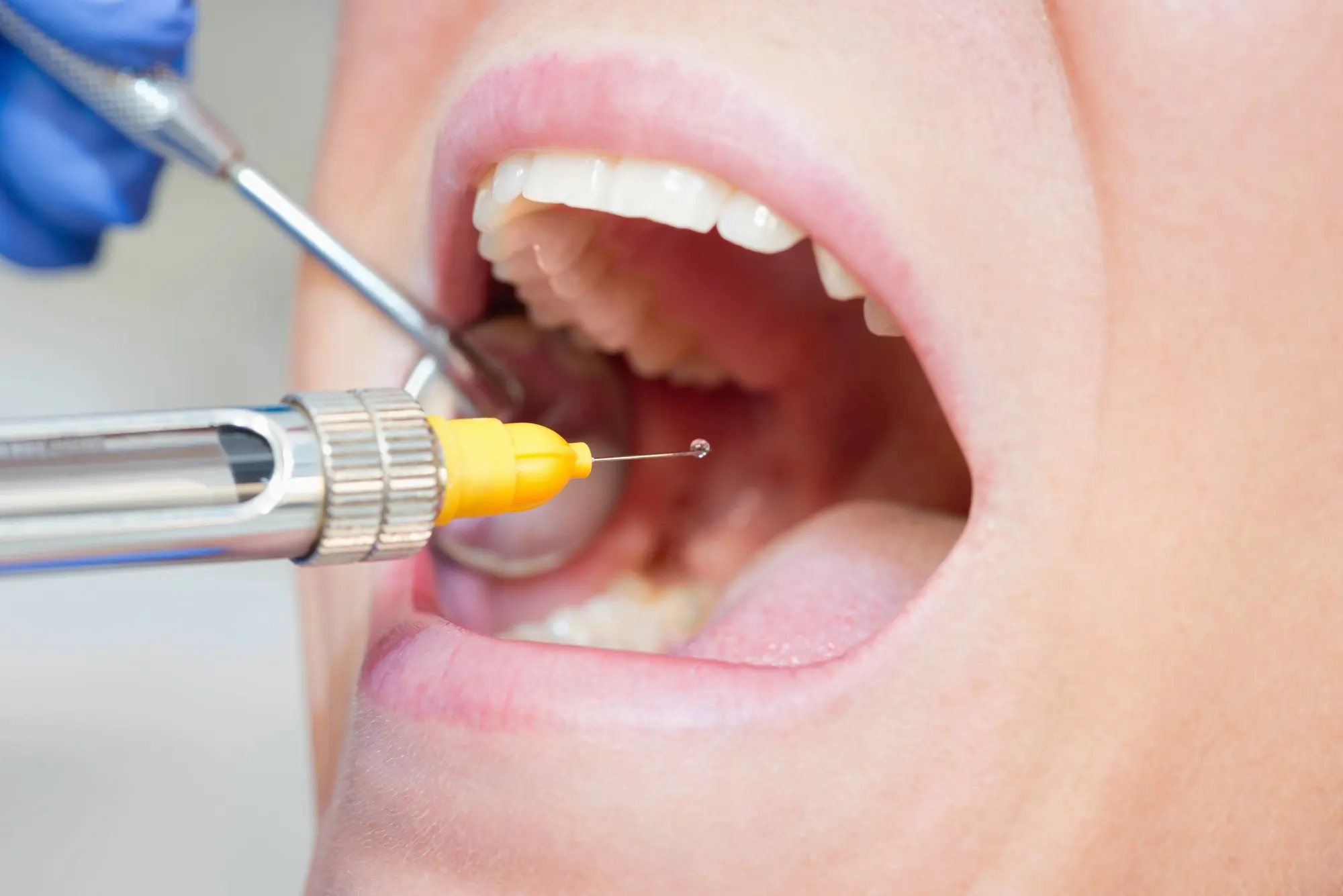 Close-up of dental anesthetic treatment during an emergency dentist Frankfort KY appointment