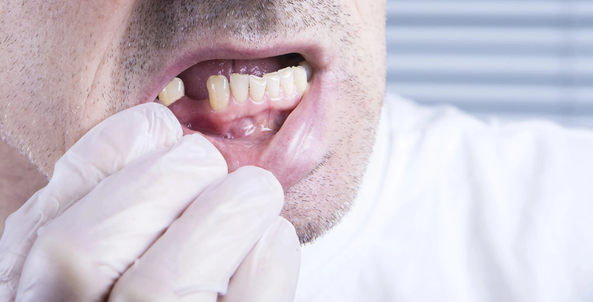 needing Dental Implants Lexington KY