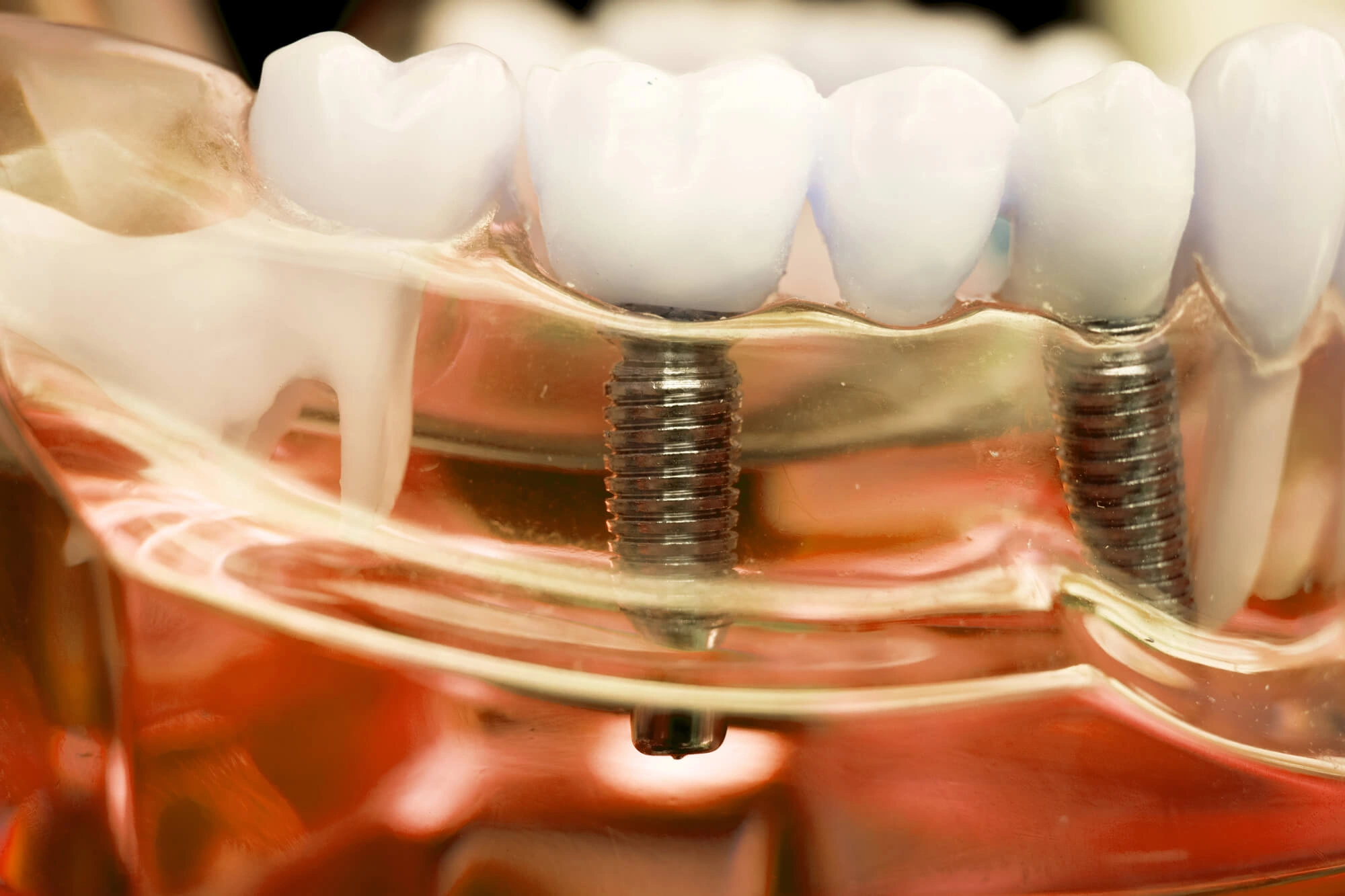 tooth-model-of-Al-on-X-Dental-Implants