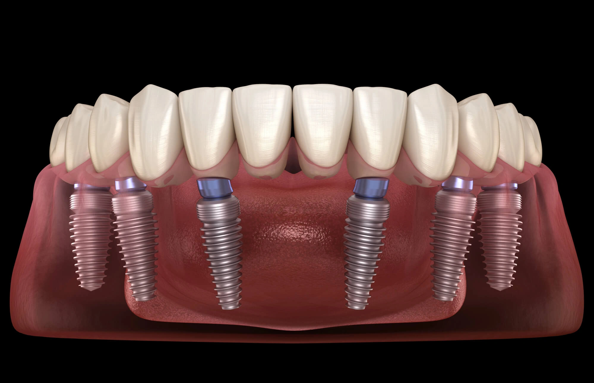 Illustration of Full Arch Implants