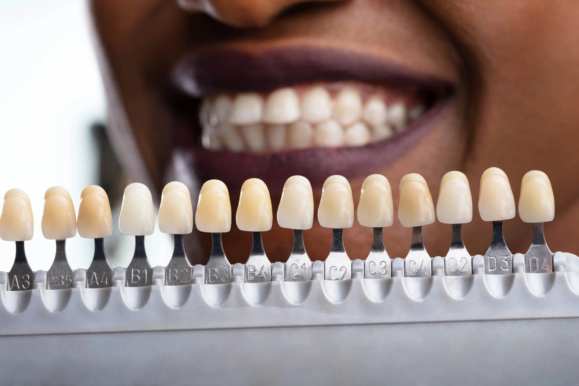 during Teeth Whitening in Georgetown