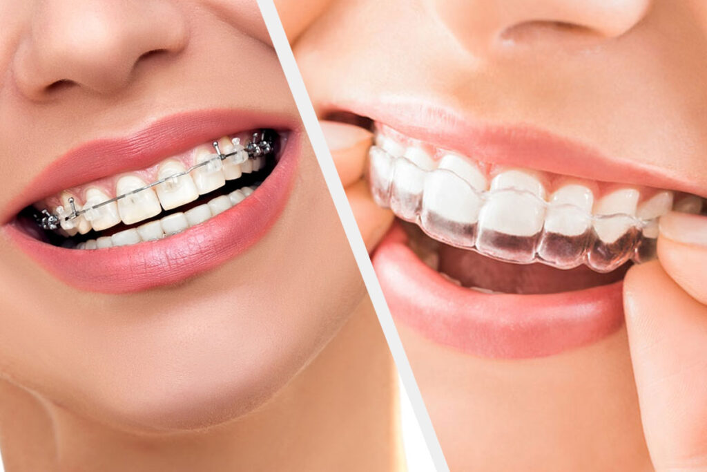 Invisalign vs Braces: Which is the Best Option for Straightening Your Teeth?