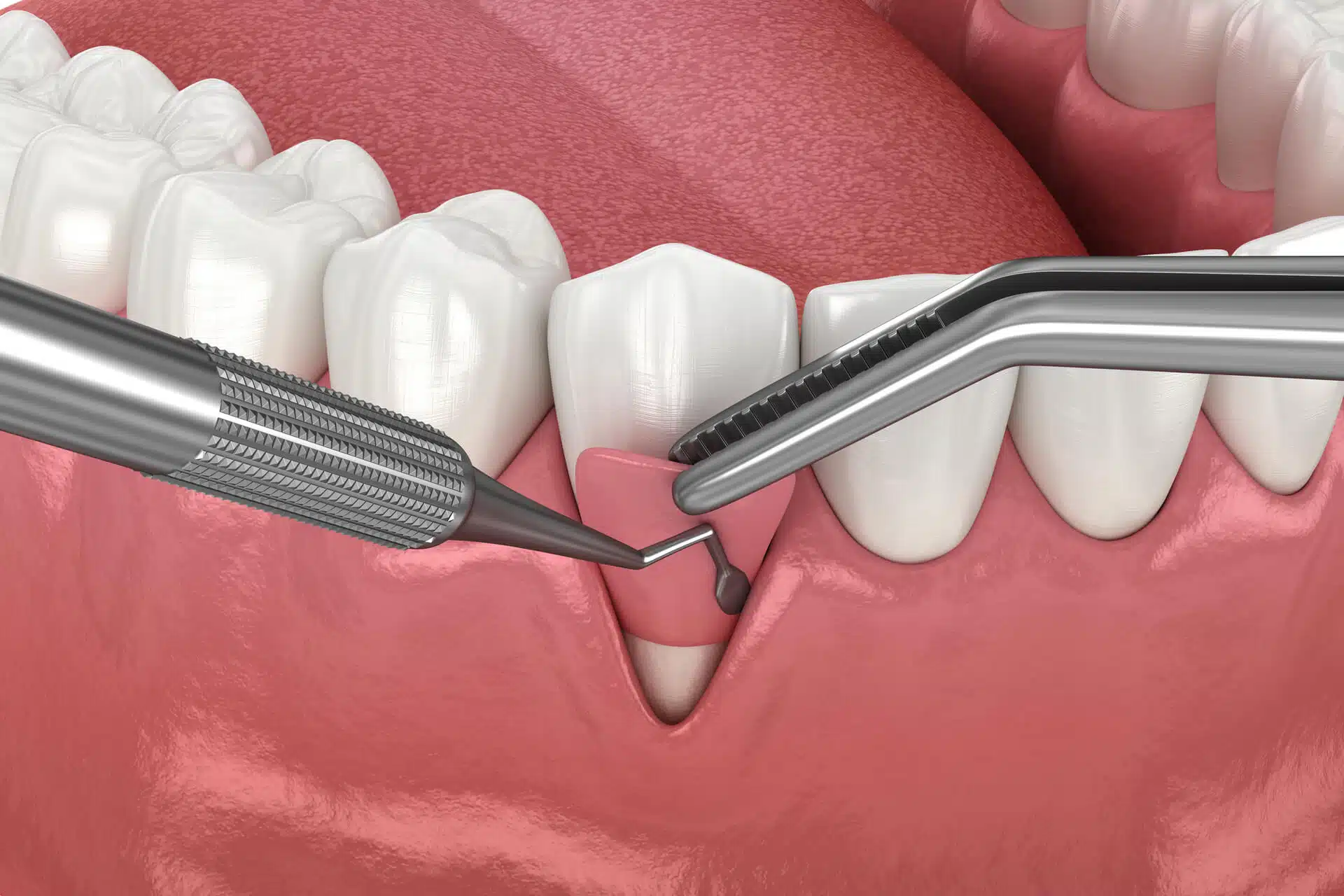 Gum Graft Surgery: What You Need to Know Before It’s Too Late