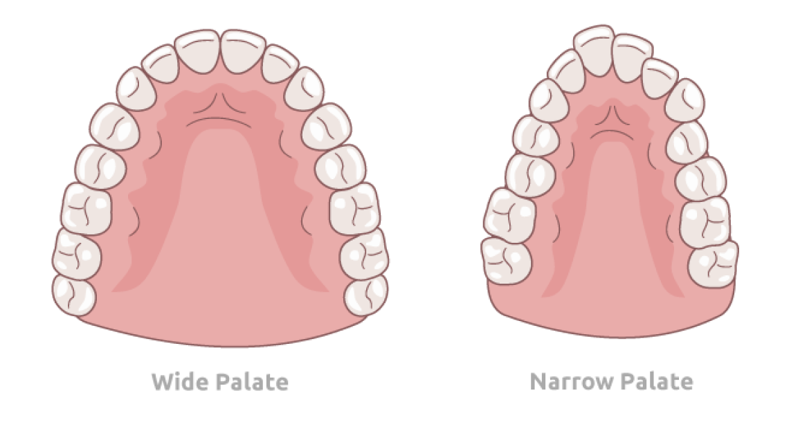 Narrow Palate in Adults: What Canadian Patients Need to Know About Treatment Options