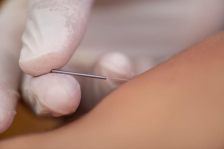Precision insertion of acupuncture needle by gloved hand.