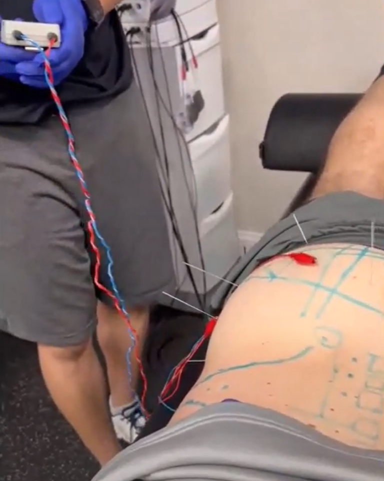 Acupuncture with electrodes on patient's lower back.