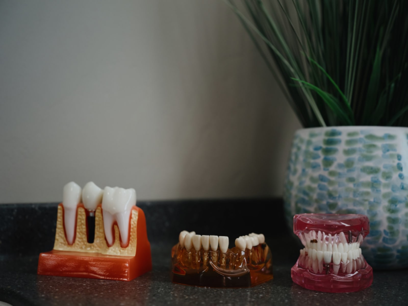 Dental veneer models on display showing smile transformation results