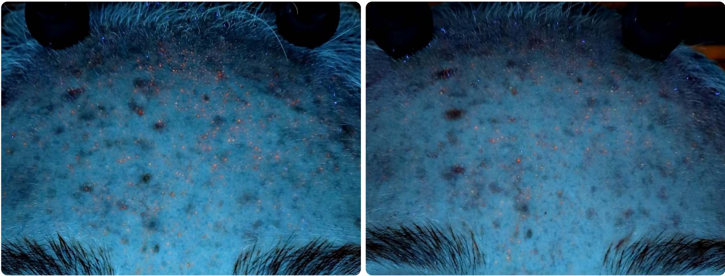 Obraz w świetle UV. Pomarańczowe punkty to fluorescencja porfiryn wytwarzanych przez C. acnes. Po lewej stan przed terapią, po prawej po serii zabiegów.