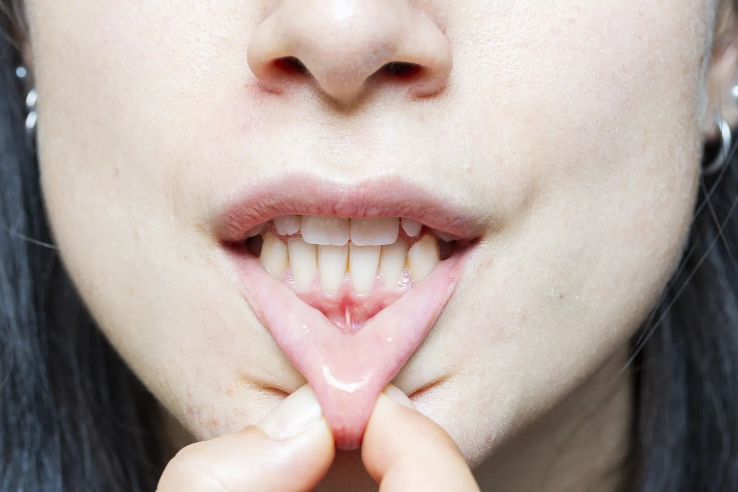 Periodontal Care in Zephyrhills, FL | Beachwood Dental