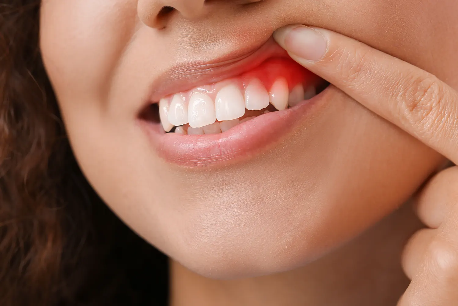 Periodontal Care in Zephyrhills, FL | Beachwood Dental