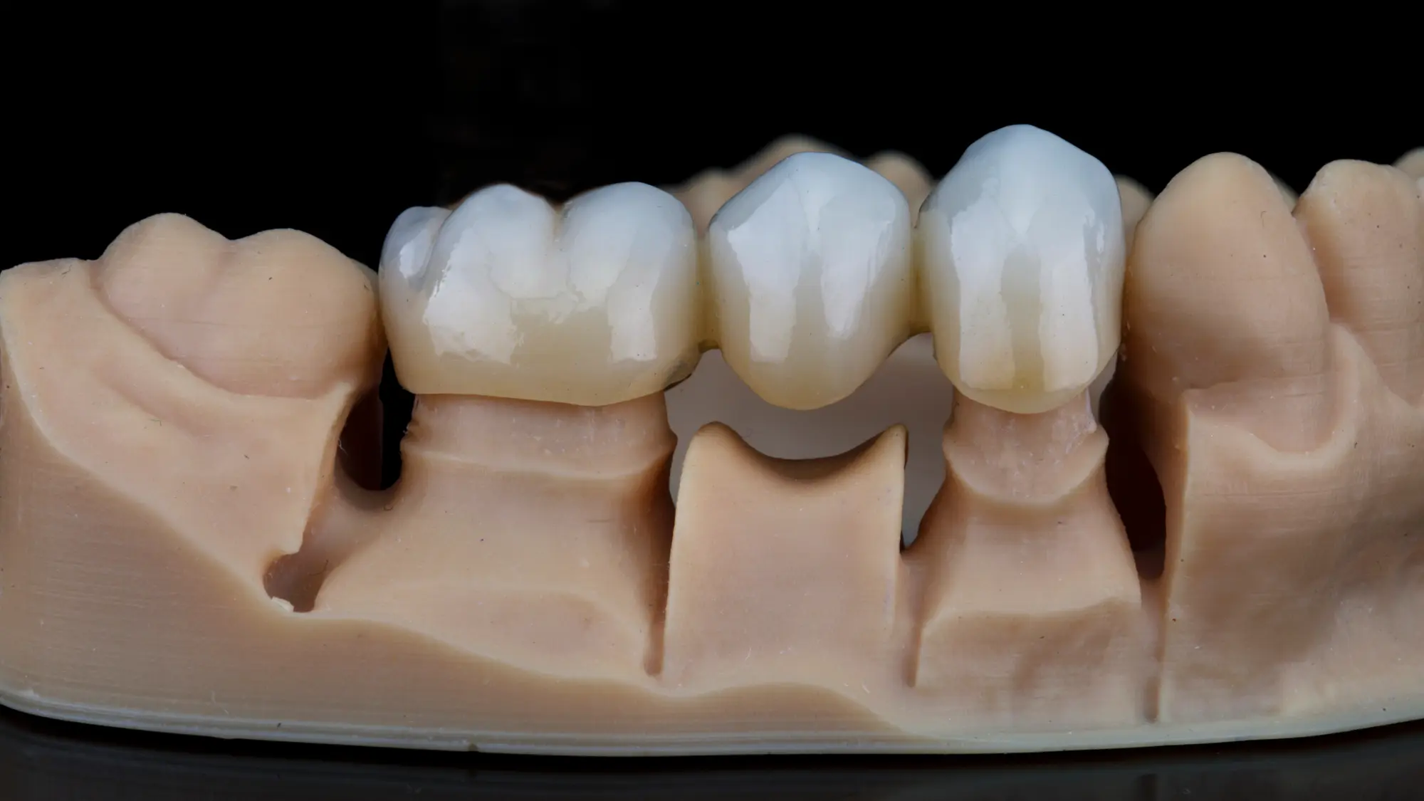 Dental Bridges: A Seamless and Stable Way to Restore Your Smile’s Function