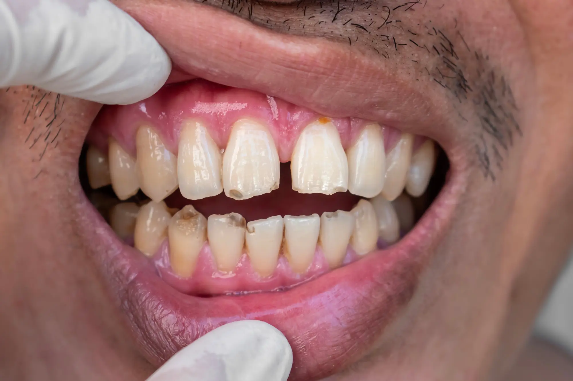 Chipped or Broken Tooth: Should You Seek Emergency Care or Wait for a Regular Appointment?
