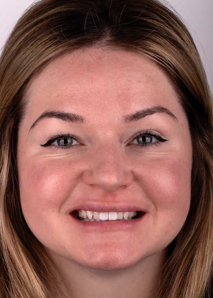 Before and after of patients teeth after a Smiles Family Dentistry Smile Makeover
