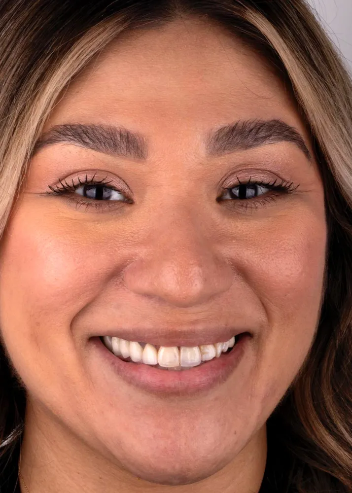 Before and after of patients teeth after a Smiles Family Dentistry Smile Makeover
