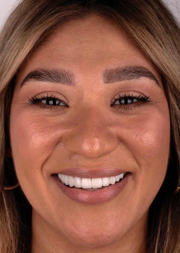 Before and after of patient's teeth after receiving veneers