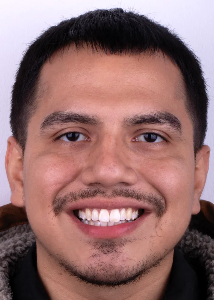Before and after of patients teeth after a Smiles Family Dentistry Smile Makeover