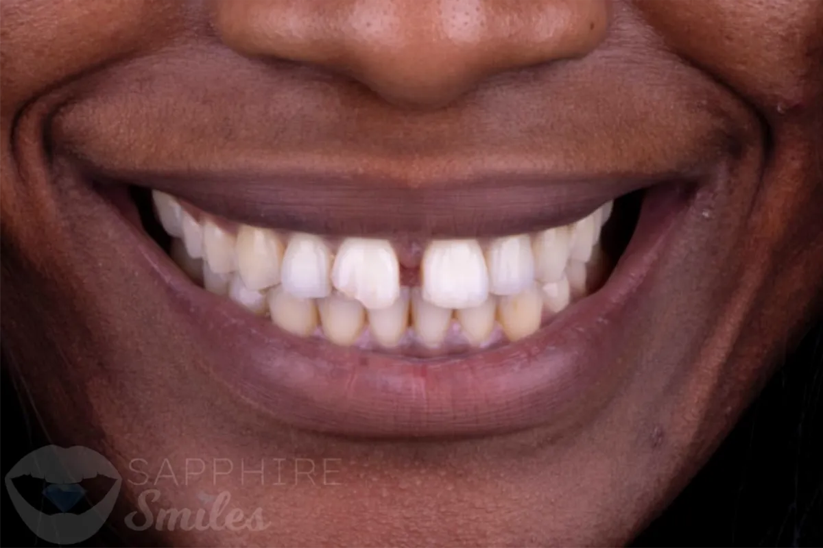 Before and after of patients teeth after a Smiles Family Dentistry Smile Makeover