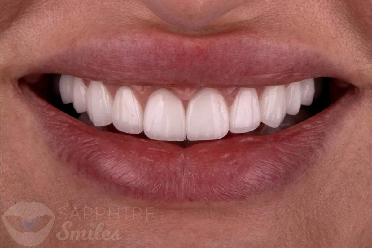 Before and after of patient's teeth after receiving veneers
