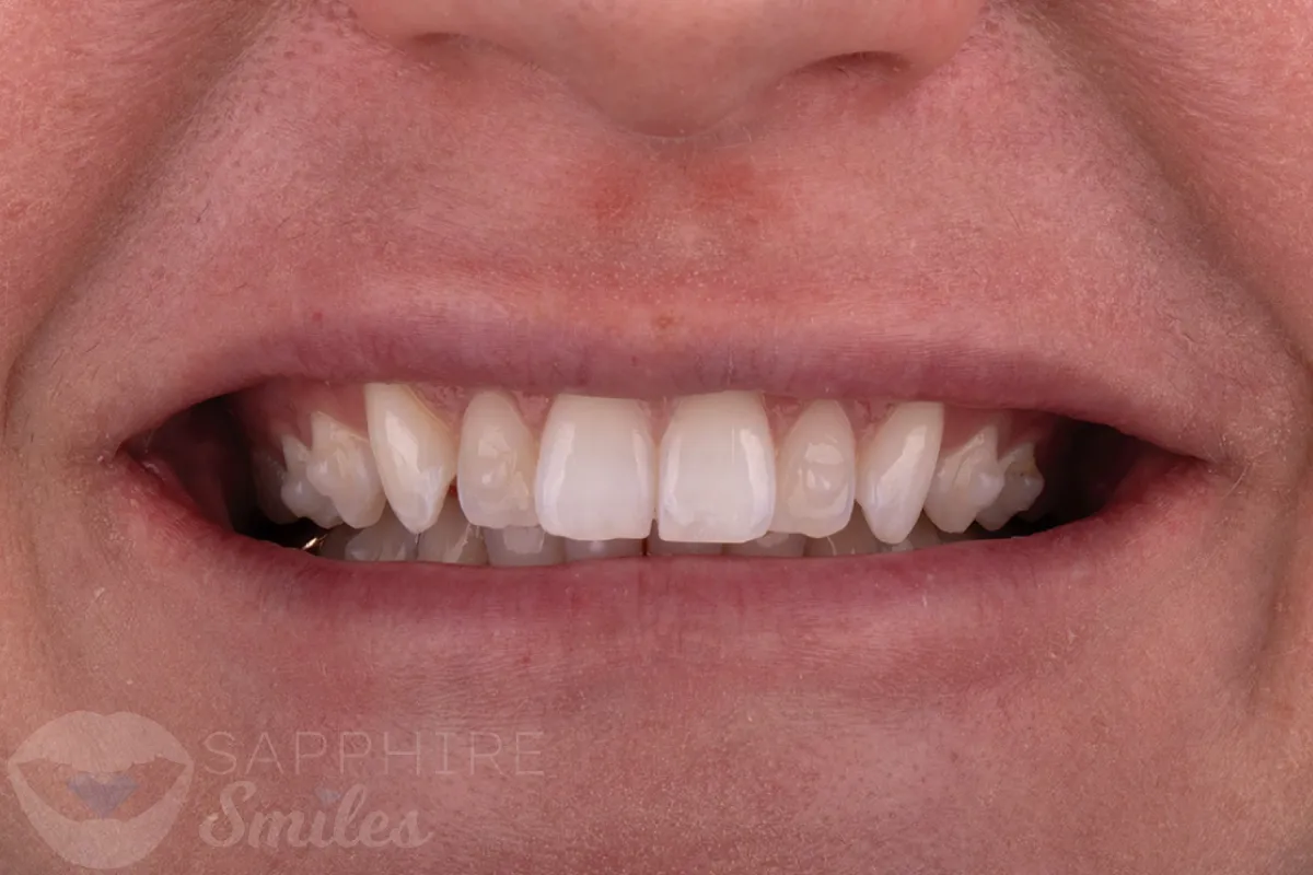Before and after of patients teeth after a Smiles Family Dentistry Smile Makeover