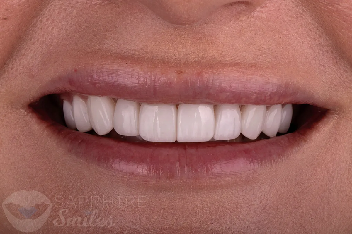 Before and after of patient's teeth after receiving veneers