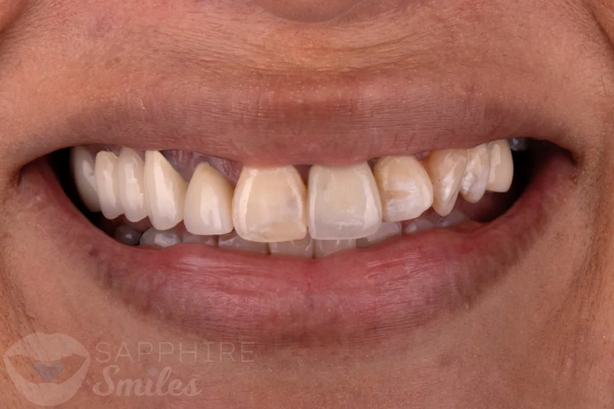 Before and after of patients teeth after a Smiles Family Dentistry Smile Makeover
