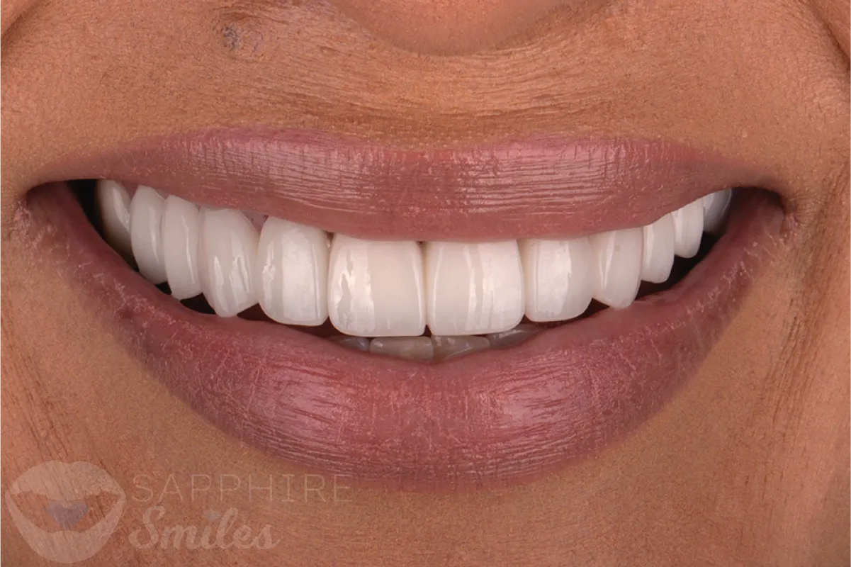 Before and after of patient's teeth after receiving veneers