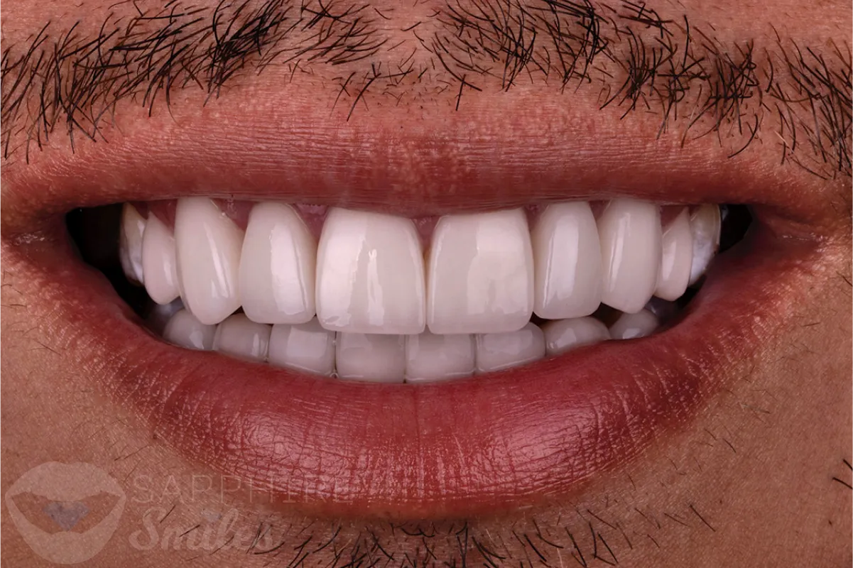 Before and after of patient's teeth after receiving veneers