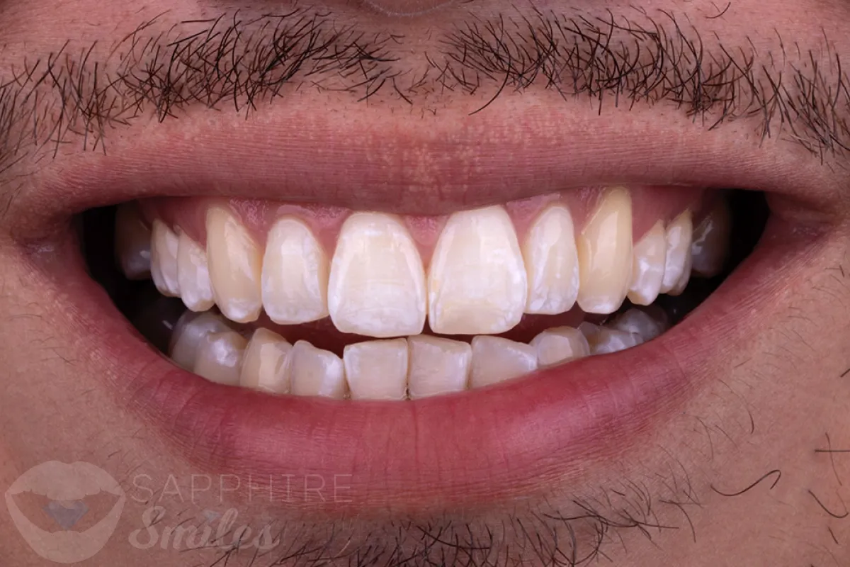 Before and after of patients teeth after a Smiles Family Dentistry Smile Makeover