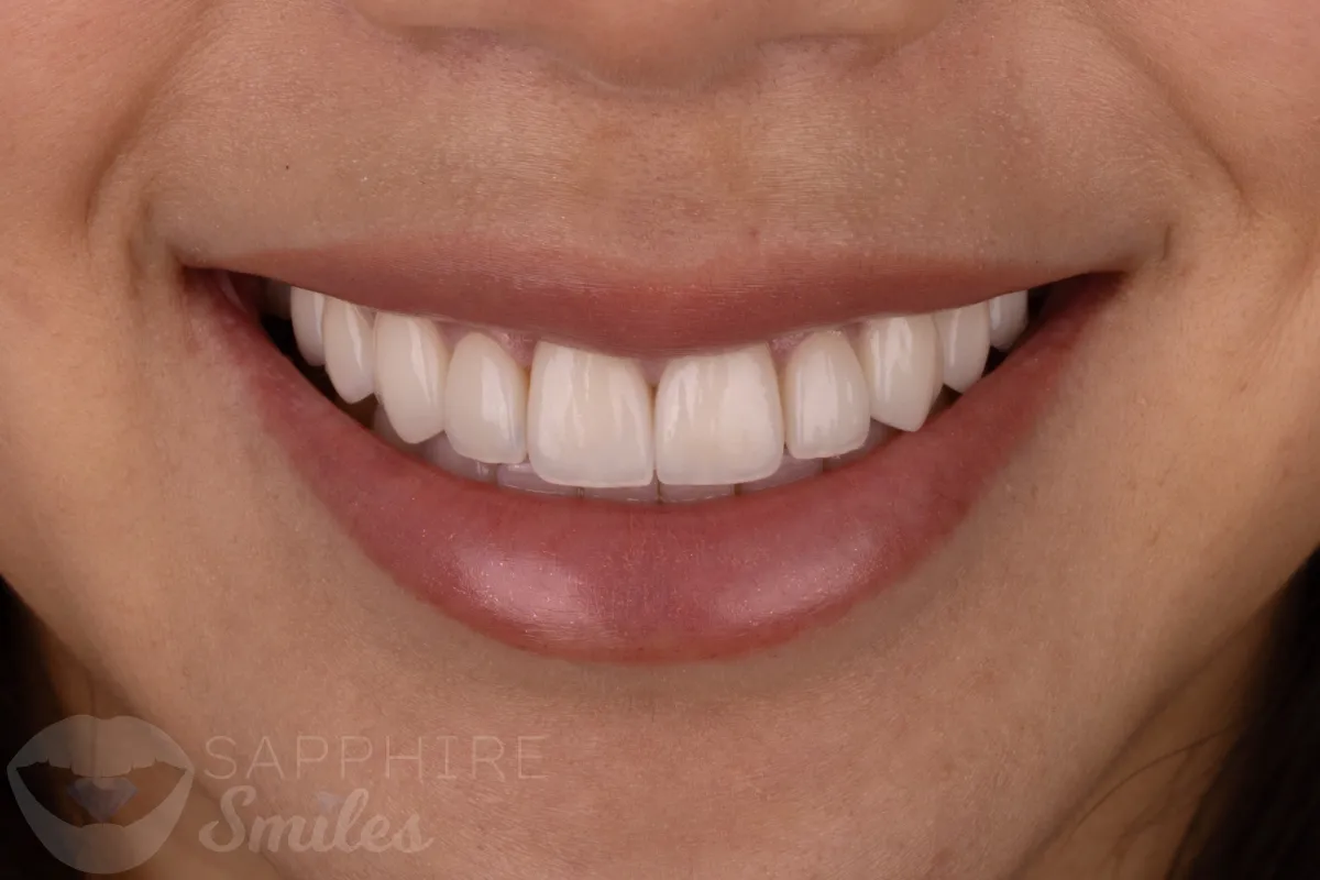 Before and after of patient's teeth after receiving veneers