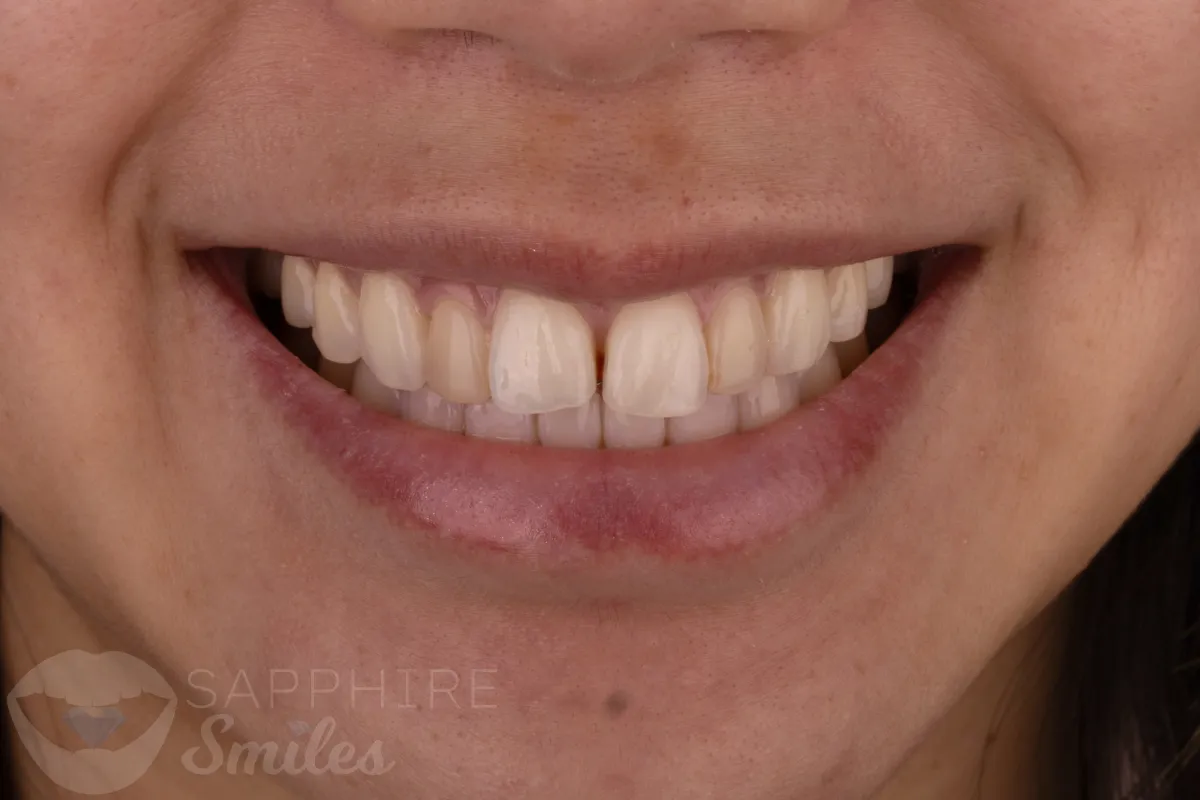 Before and after of patients teeth after a Smiles Family Dentistry Smile Makeover