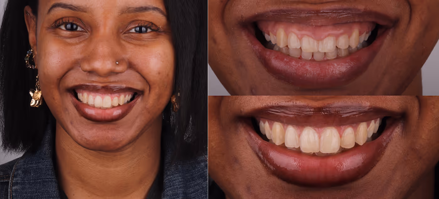 Gum Contouring at Sapphire Smiles