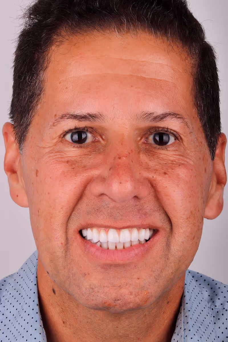 Actual patient of Sapphire Smiles