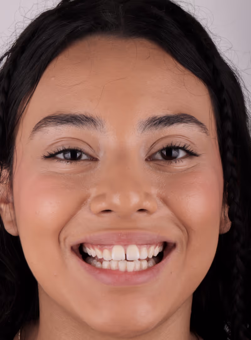 Patient before dental implants at Sapphire Smiles