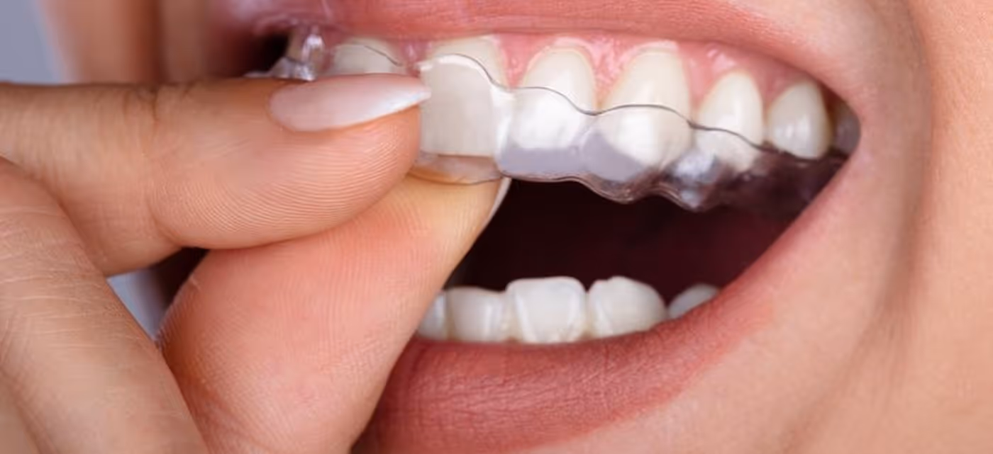 Start wearing aligners from Sapphire Smiles