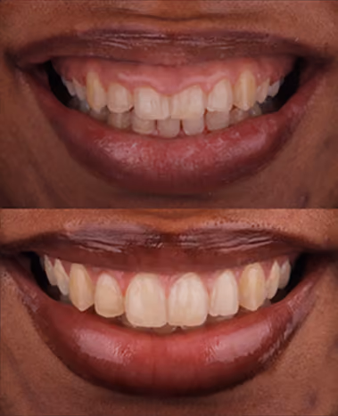 Gum Contouring at Sapphire Smiles