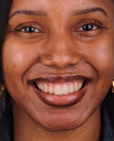Gum Contouring at Sapphire Smiles