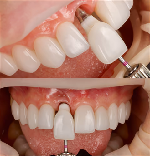 Recovery and bone integration at Sapphire Smiles