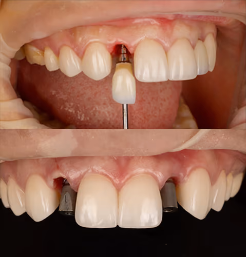 Attaching the connector at Sapphire Smiles
