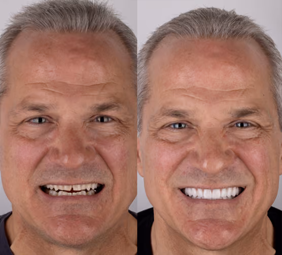 Final restoration at Sapphire Smiles