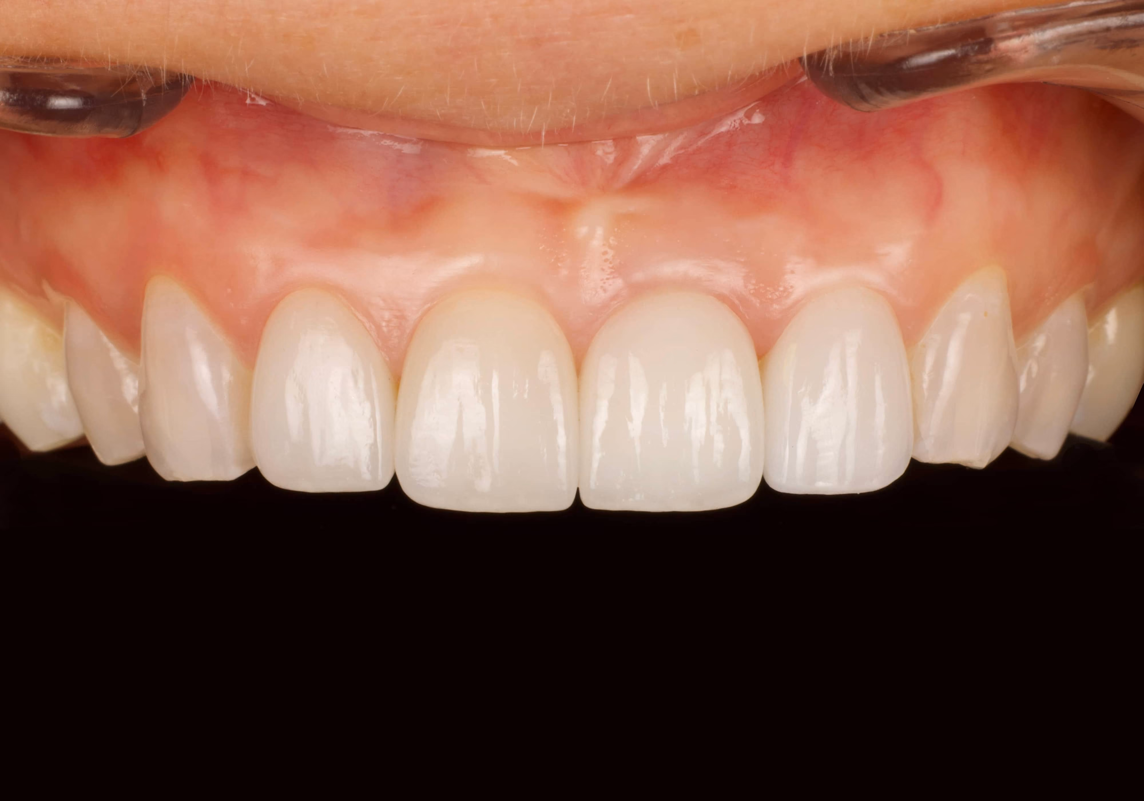 dental implant after closeup