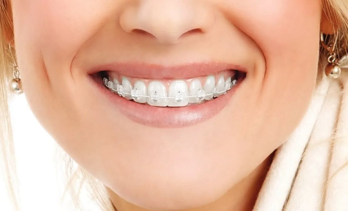 braces