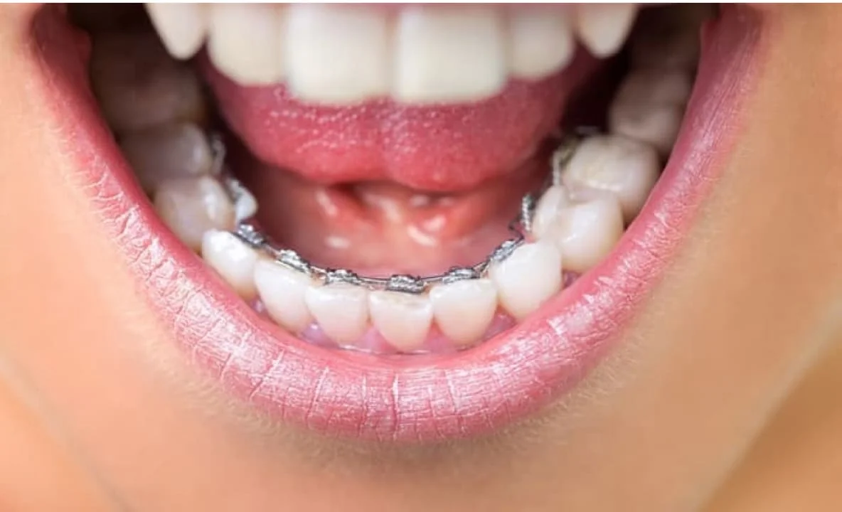 braces